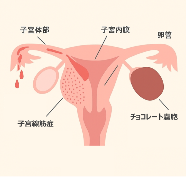 子宮のイラスト