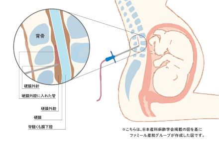 硬膜外麻酔の方法